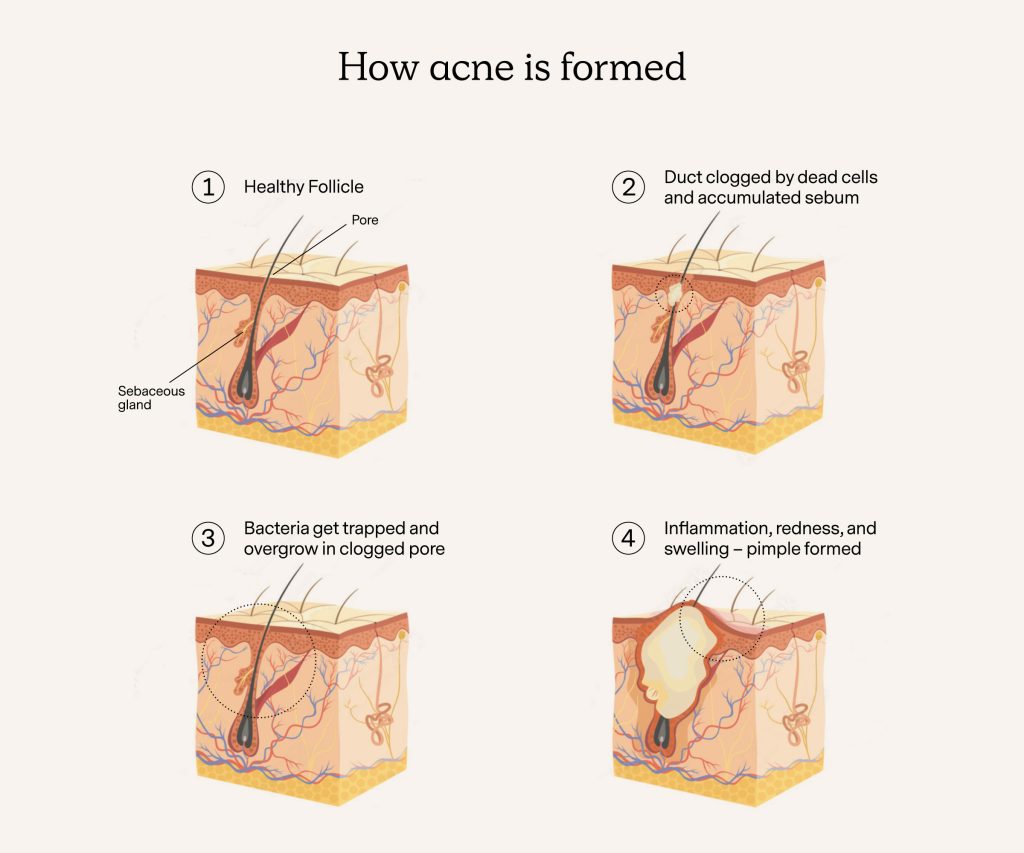 Acne: “Diabetes of Skin?” - Moyem